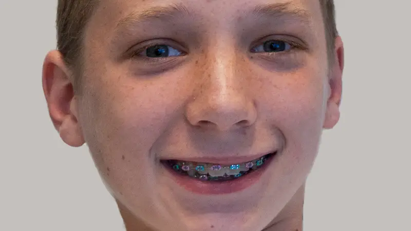 patient in traditional braces close up